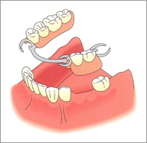 protesi dentale mobile