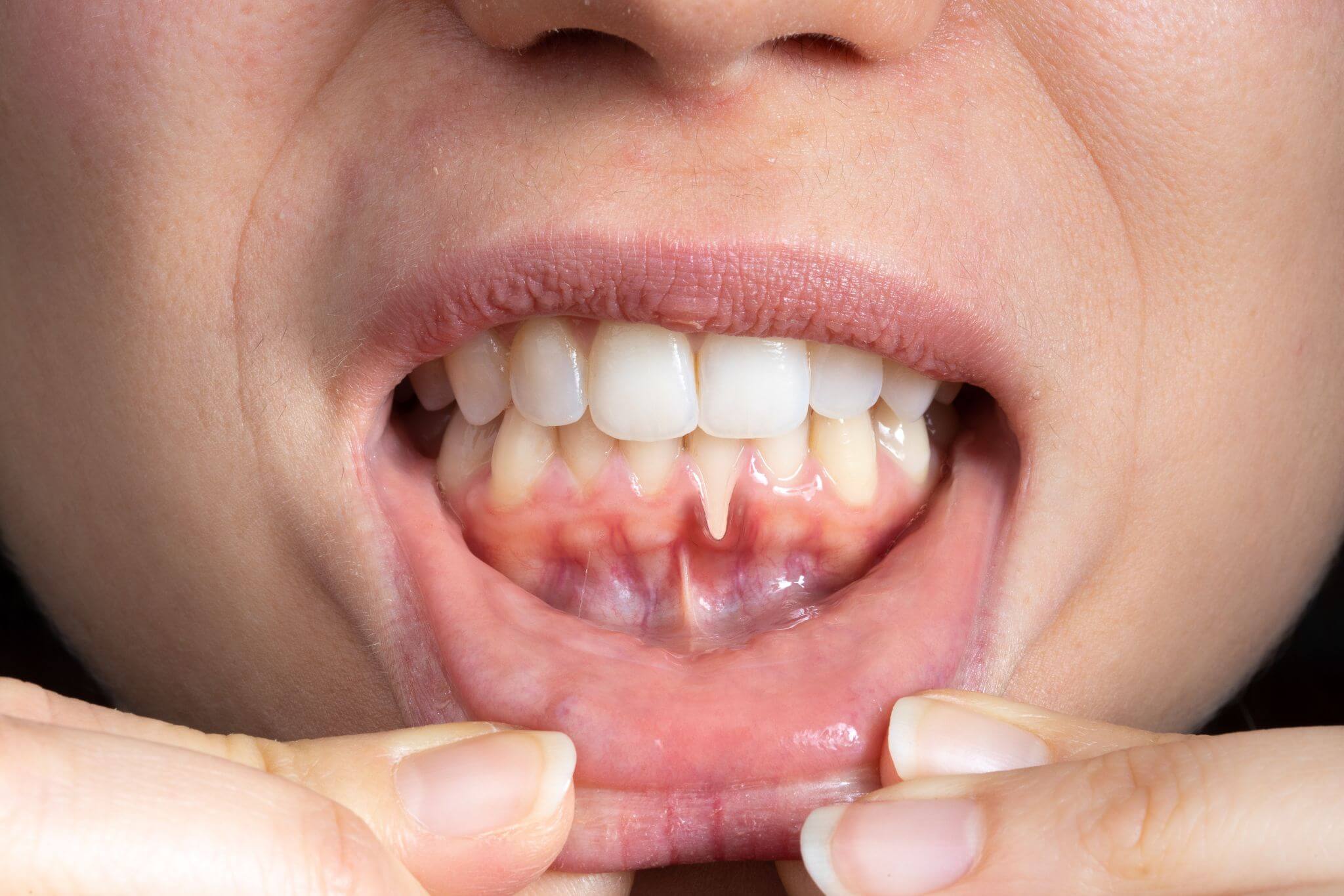 come si cura la piorrea Dentisti Croazia