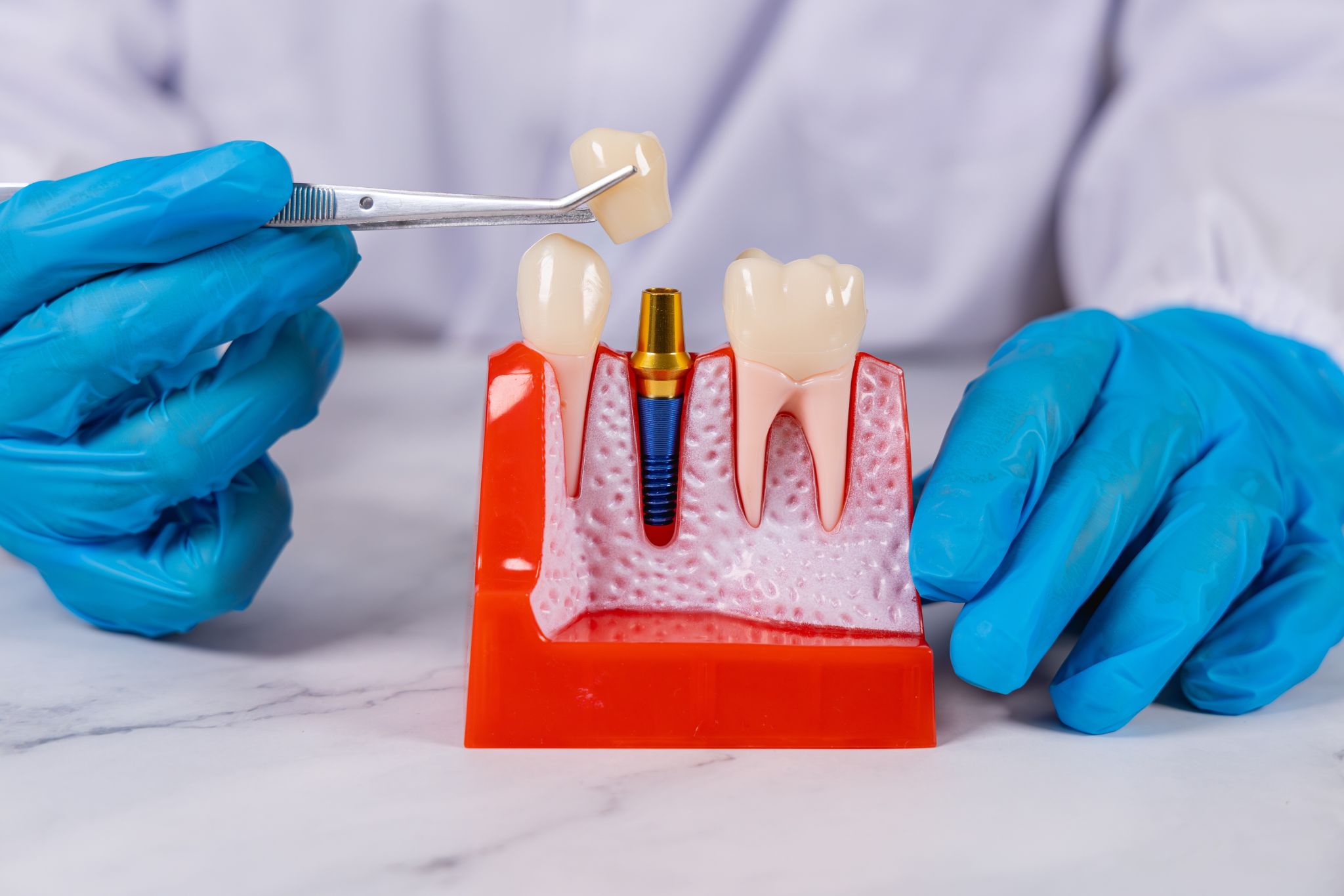 quanto costa impianto dentale in croazia