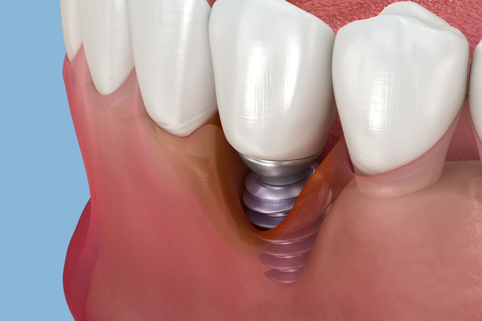 Impianti dentali con poco osso le soluzioni in Croazia