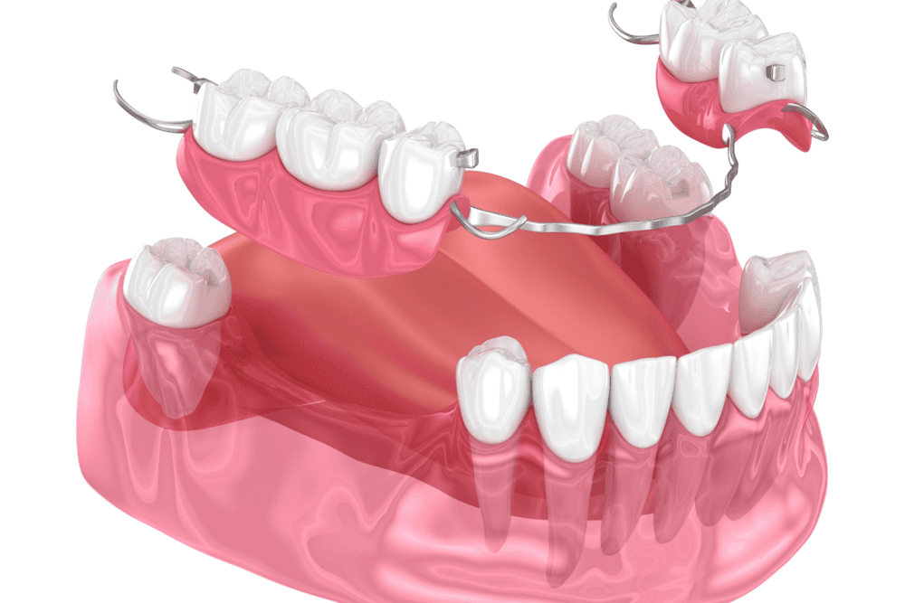 ponte mobile denti Dentisti Croazia
